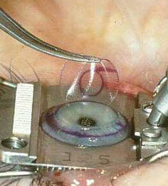 روش‌های درمان بیماری‌های چشمی